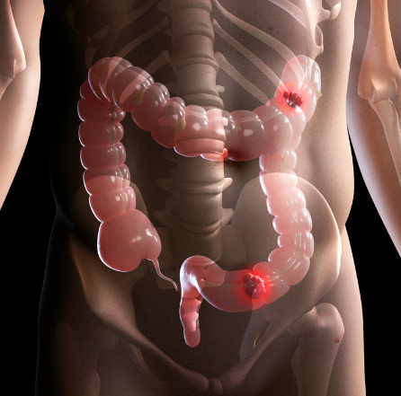 Nikhil Pawa - Inflammatory Bowel Disease
